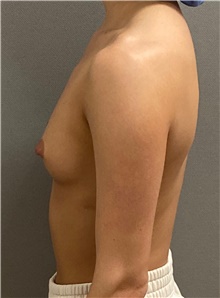 Breast Augmentation Before Photo by Keshav Magge, MD; Bethesda, MD - Case 49239