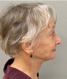 Facelift After Photo by Keshav Magge, MD; Bethesda, MD - Case 49244