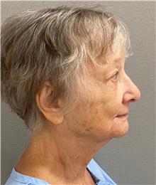 Facelift Before Photo by Keshav Magge, MD; Bethesda, MD - Case 49244