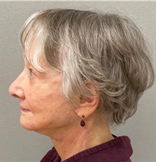 Facelift After Photo by Keshav Magge, MD; Bethesda, MD - Case 49244