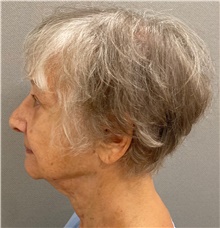 Facelift Before Photo by Keshav Magge, MD; Bethesda, MD - Case 49244