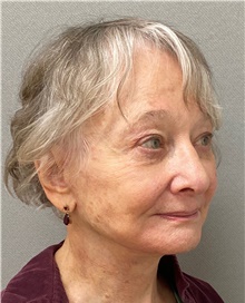 Facelift After Photo by Keshav Magge, MD; Bethesda, MD - Case 49244