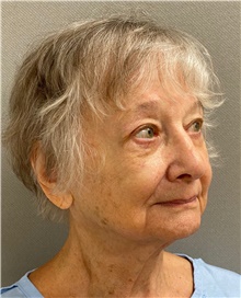 Facelift Before Photo by Keshav Magge, MD; Bethesda, MD - Case 49244