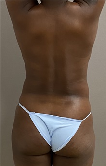 Buttock Lift with Augmentation Before Photo by Keshav Magge, MD; Bethesda, MD - Case 49264