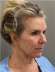 Facelift Before Photo by Keshav Magge, MD; Bethesda, MD - Case 49281