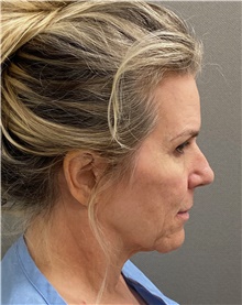 Facelift Before Photo by Keshav Magge, MD; Bethesda, MD - Case 49281