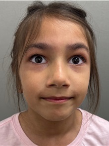 Ear Surgery After Photo by Keshav Magge, MD; ,  - Case 50289