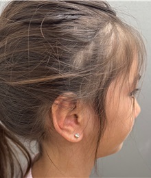 Ear Surgery After Photo by Keshav Magge, MD; ,  - Case 50289