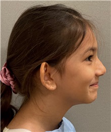 Ear Surgery Before Photo by Keshav Magge, MD; ,  - Case 50289