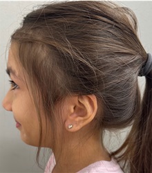 Ear Surgery After Photo by Keshav Magge, MD; ,  - Case 50289