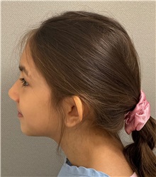 Ear Surgery Before Photo by Keshav Magge, MD; ,  - Case 50289