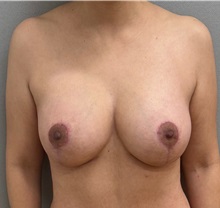 Breast Lift After Photo by Keshav Magge, MD; ,  - Case 50336