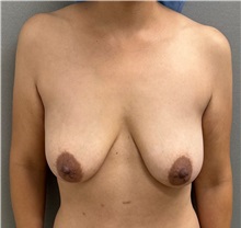 Breast Lift Before Photo by Keshav Magge, MD; ,  - Case 50336
