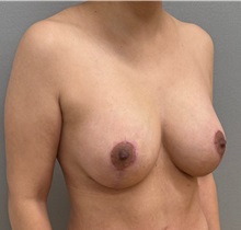 Breast Lift After Photo by Keshav Magge, MD; ,  - Case 50336