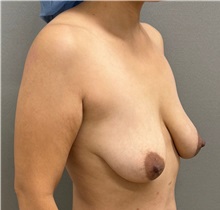 Breast Lift Before Photo by Keshav Magge, MD; ,  - Case 50336