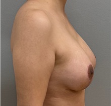 Breast Lift After Photo by Keshav Magge, MD; ,  - Case 50336