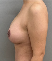 Breast Lift After Photo by Keshav Magge, MD; ,  - Case 50336
