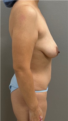 Mommy Makeover Before Photo by Keshav Magge, MD; ,  - Case 50338