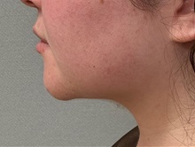 Liposuction After Photo by Keshav Magge, MD; ,  - Case 50335