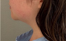 Liposuction Before Photo by Keshav Magge, MD; ,  - Case 50335