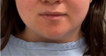 Liposuction Before Photo by Keshav Magge, MD; ,  - Case 50335