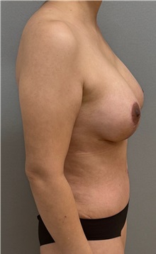 Tummy Tuck After Photo by Keshav Magge, MD; ,  - Case 50337