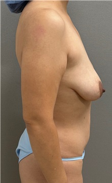 Tummy Tuck Before Photo by Keshav Magge, MD; ,  - Case 50337