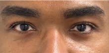 Eyelid Surgery After Photo by Keshav Magge, MD; ,  - Case 50347