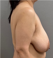 Breast Lift Before Photo by Keshav Magge, MD; ,  - Case 50429