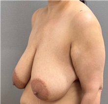 Breast Lift Before Photo by Keshav Magge, MD; ,  - Case 50429