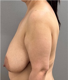 Breast Lift Before Photo by Keshav Magge, MD; ,  - Case 50429