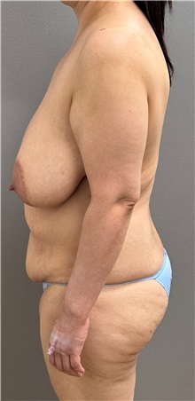 Mommy Makeover Before Photo by Keshav Magge, MD; ,  - Case 50430