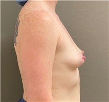 Breast Augmentation Before Photo by Keshav Magge, MD; ,  - Case 50434