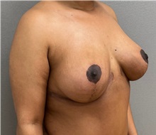 Breast Lift After Photo by Keshav Magge, MD; ,  - Case 50464