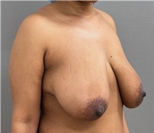 Breast Lift Before Photo by Keshav Magge, MD; ,  - Case 50464