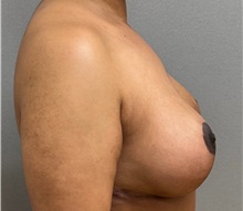 Breast Lift After Photo by Keshav Magge, MD; ,  - Case 50464