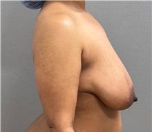 Breast Lift Before Photo by Keshav Magge, MD; ,  - Case 50464