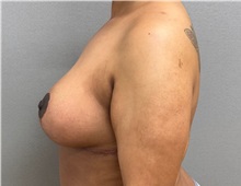 Breast Lift After Photo by Keshav Magge, MD; ,  - Case 50464