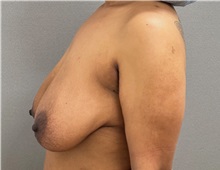 Breast Lift Before Photo by Keshav Magge, MD; ,  - Case 50464