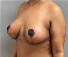 Breast Lift After Photo by Keshav Magge, MD; ,  - Case 50464