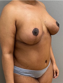 Mommy Makeover After Photo by Keshav Magge, MD; ,  - Case 50468