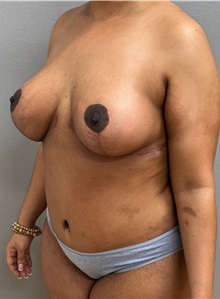 Mommy Makeover After Photo by Keshav Magge, MD; ,  - Case 50468