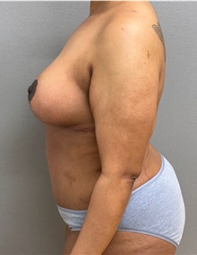 Mommy Makeover After Photo by Keshav Magge, MD; ,  - Case 50468