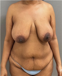 Tummy Tuck Before Photo by Keshav Magge, MD; ,  - Case 50466