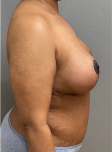Tummy Tuck After Photo by Keshav Magge, MD; ,  - Case 50466