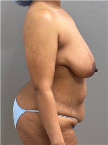Tummy Tuck Before Photo by Keshav Magge, MD; ,  - Case 50466