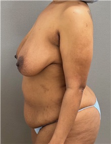 Tummy Tuck Before Photo by Keshav Magge, MD; ,  - Case 50466