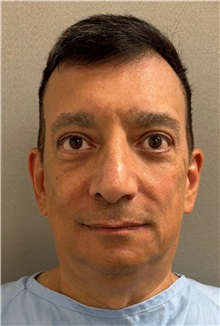 Facelift Before Photo by Keshav Magge, MD; ,  - Case 50494