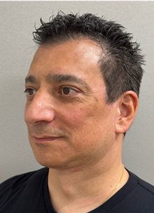 Facelift After Photo by Keshav Magge, MD; ,  - Case 50494