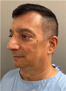 Facelift Before Photo by Keshav Magge, MD; ,  - Case 50494